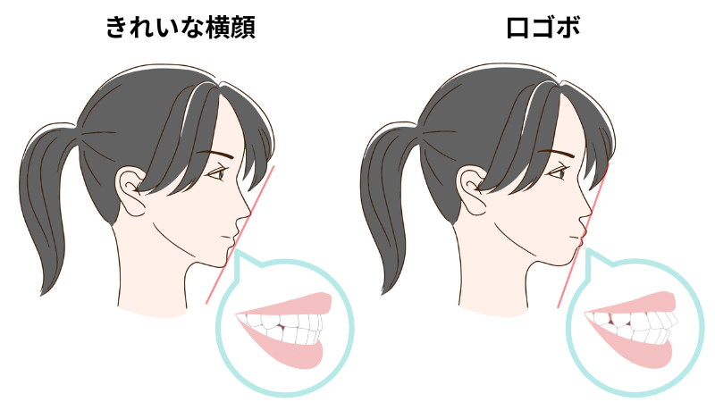 矯正治療で口ゴボになった