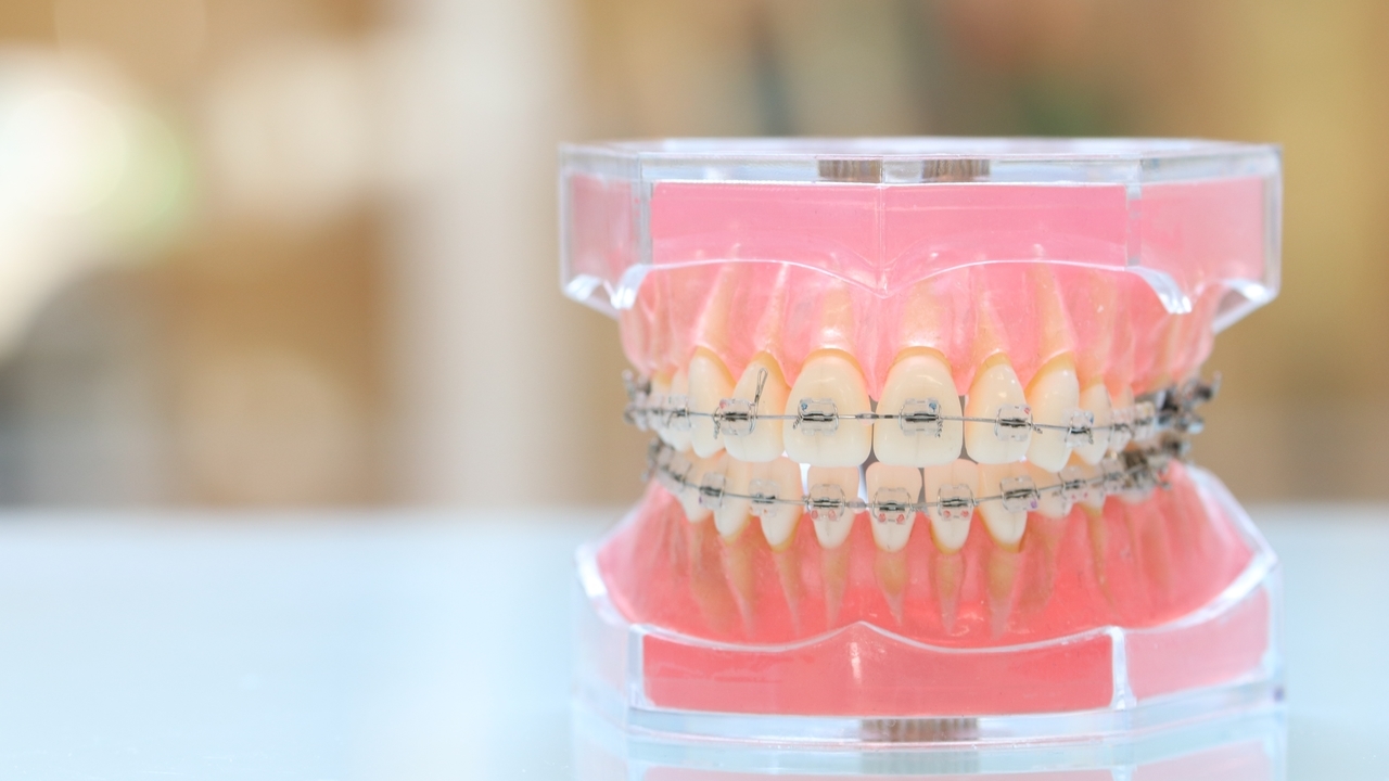 ワイヤー矯正について紹介するページへのリンク