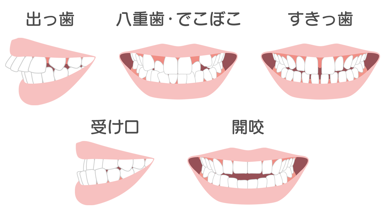 マウスピース矯正だけでは治せない場合がある