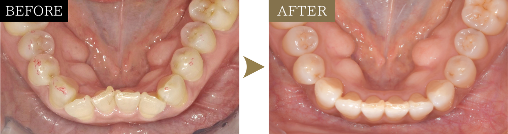 前歯の乱れと噛み合わせのズレの治療前後比較写真（下顎）