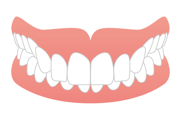 噛み合わせが深くなってしまった過蓋咬合（ディープバイト）のイラスト