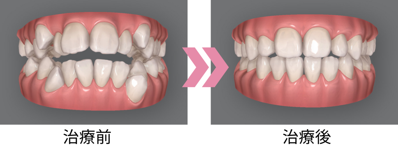 矯正前の歯並びと矯正後の歯並びのシミュレーション画像