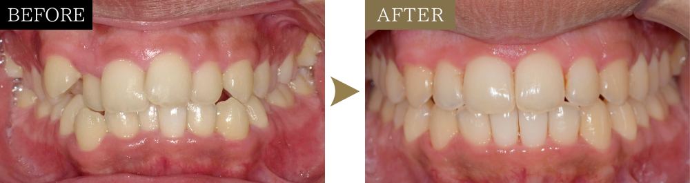 八重歯・ガタガタの治療前後比較写真（正面）