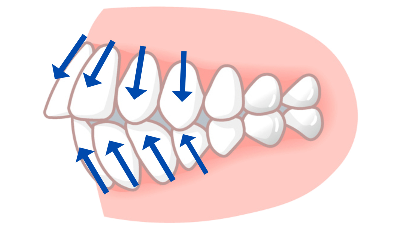 ＡＩの言うまま非抜歯矯正
