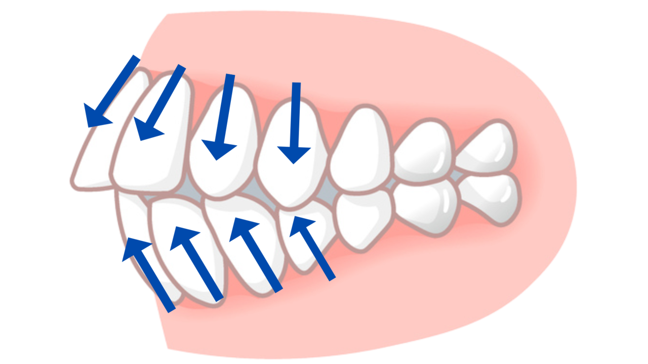 ＡＩの言うまま非抜歯矯正