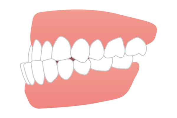 下の歯が上の歯より前に出る受け口・しゃくれ（反対咬合・下顎前突）のイラスト