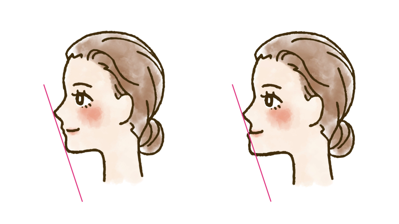 受け口（反対咬合）のEラインを整える 