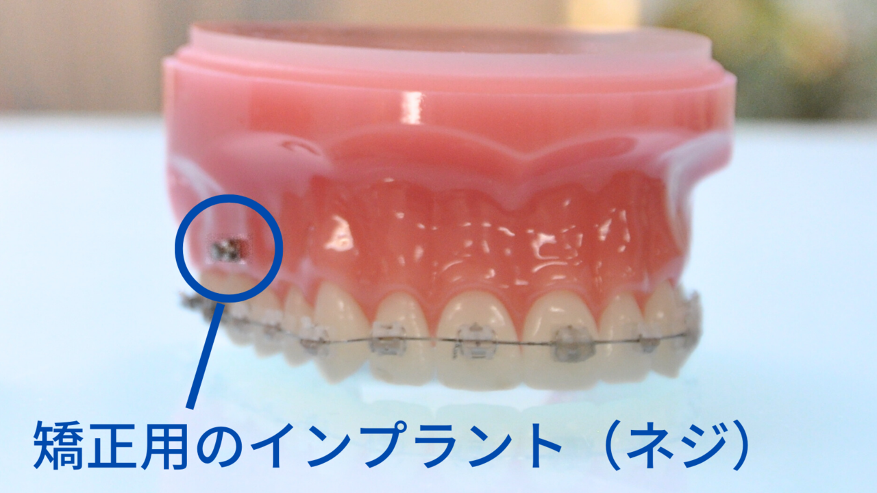 インプラント矯正について紹介するページへのリンク