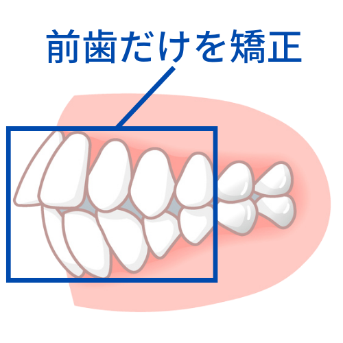 前歯だけの矯正を無理に実行