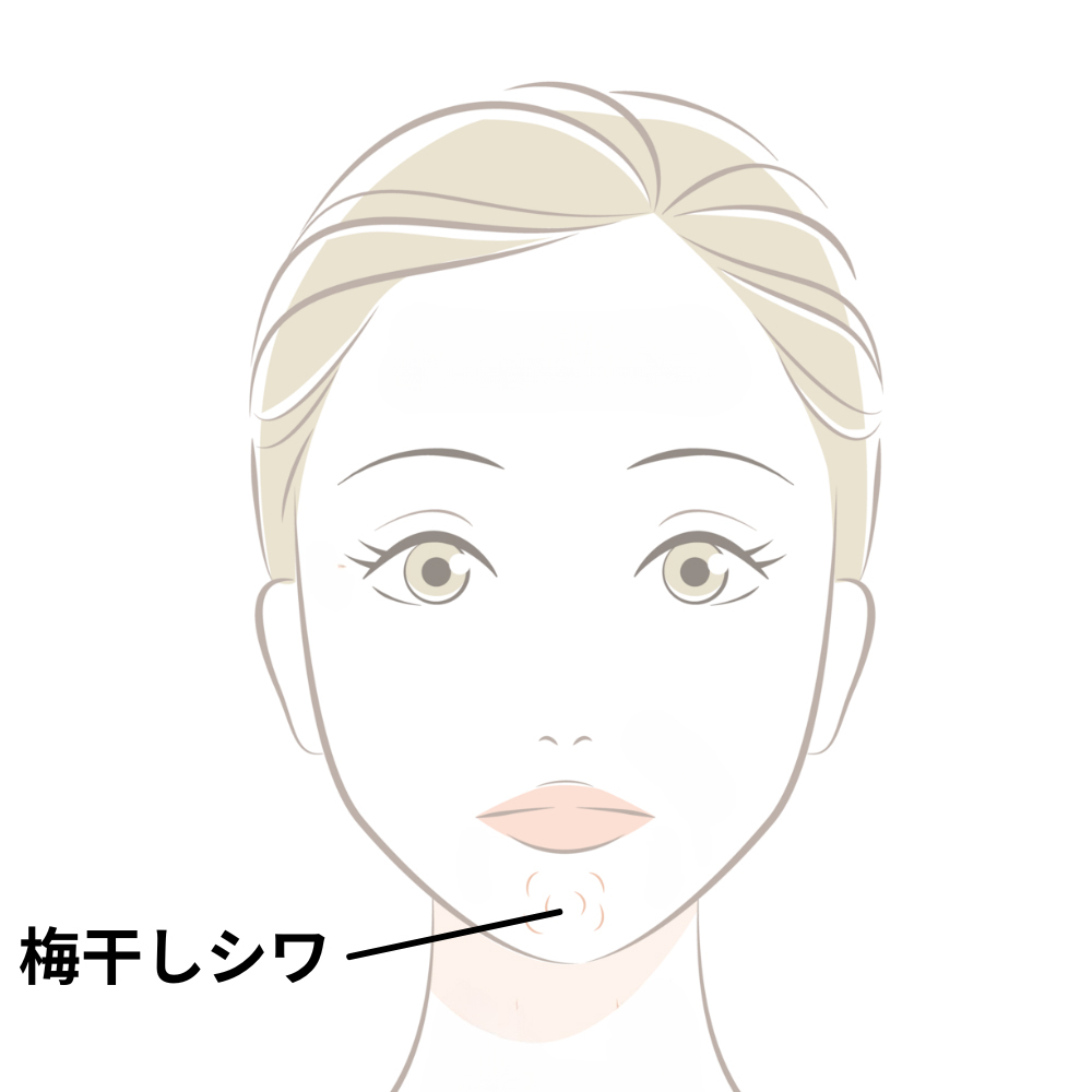 歯並びが悪いと梅干しシワ