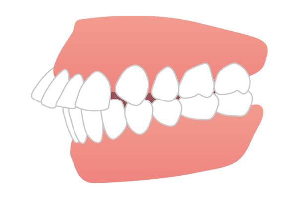 上の前歯が前方に突出している出っ歯（上顎前突）のイラスト