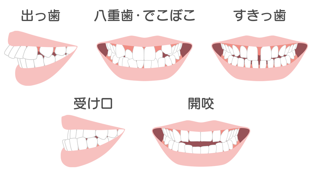 マウスピース矯正だけでは治せない場合がある