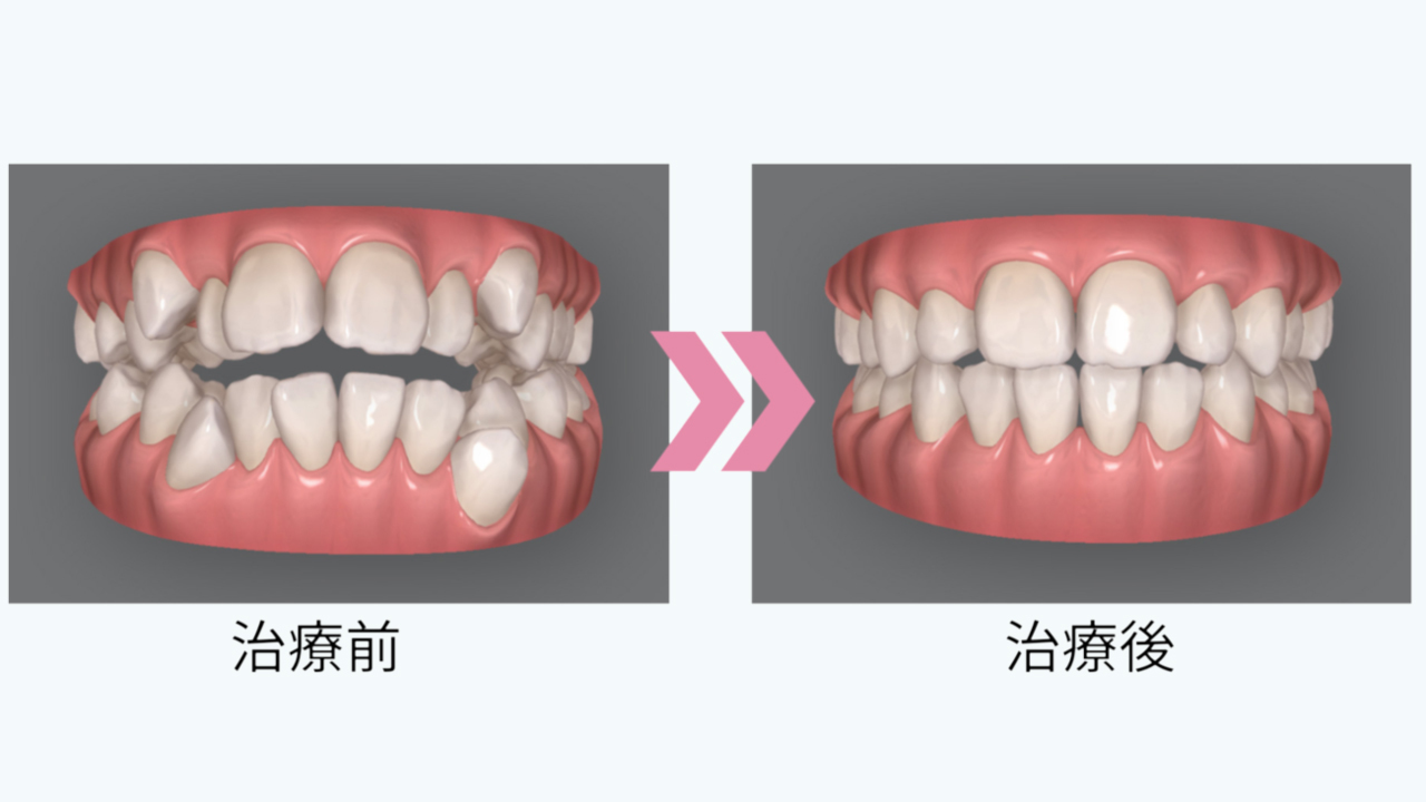 矯正治療で健康になれる