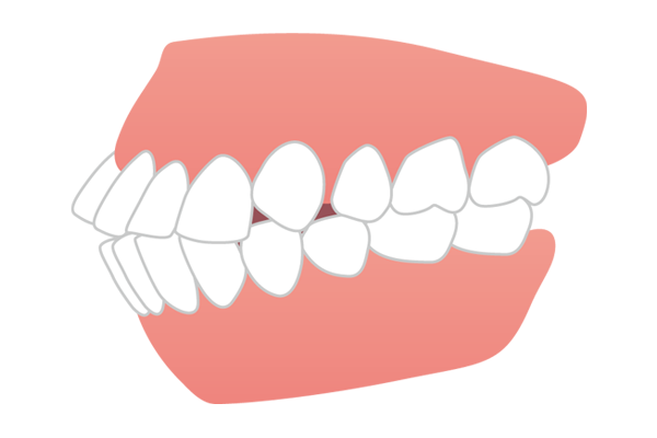 口元が前に出ているように見える口ゴボ（上下顎前突）のイラスト