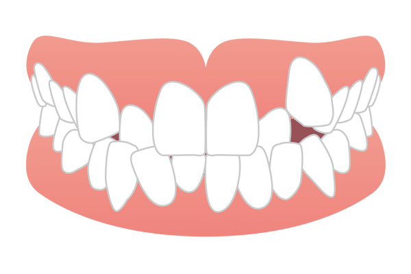 犬歯が飛び出している八重歯のイラスト