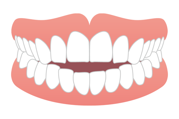 前歯が噛み合わない開咬（オープンバイト）のイラスト