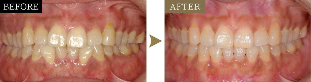 前歯の乱れと噛み合わせのズレの治療前後比較写真（正面）