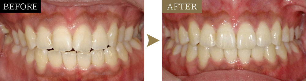 前歯のねじれ（捻転）の治療前後比較写真（正面）