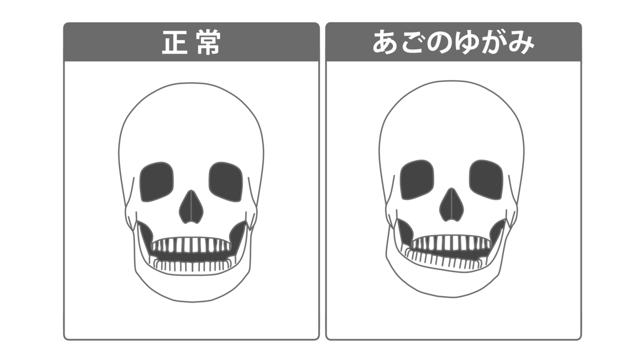 悪い噛み合わせは、目や口も歪ませる 