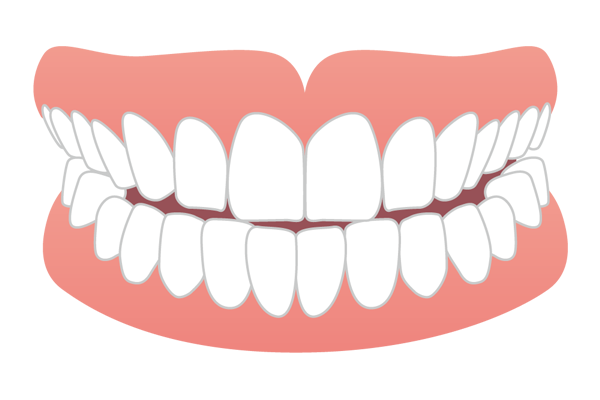 上下の前歯の先端がぶつかる切端咬合のイラスト